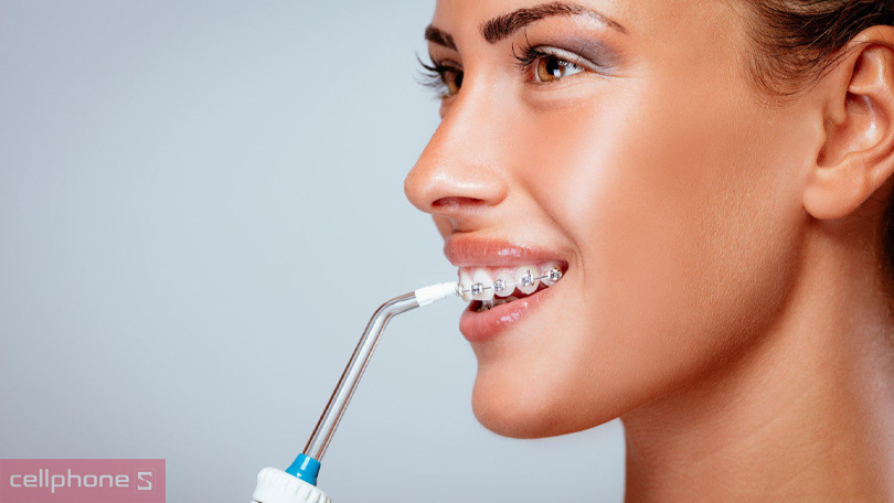 Hỗ trợ cho những người niềng răng